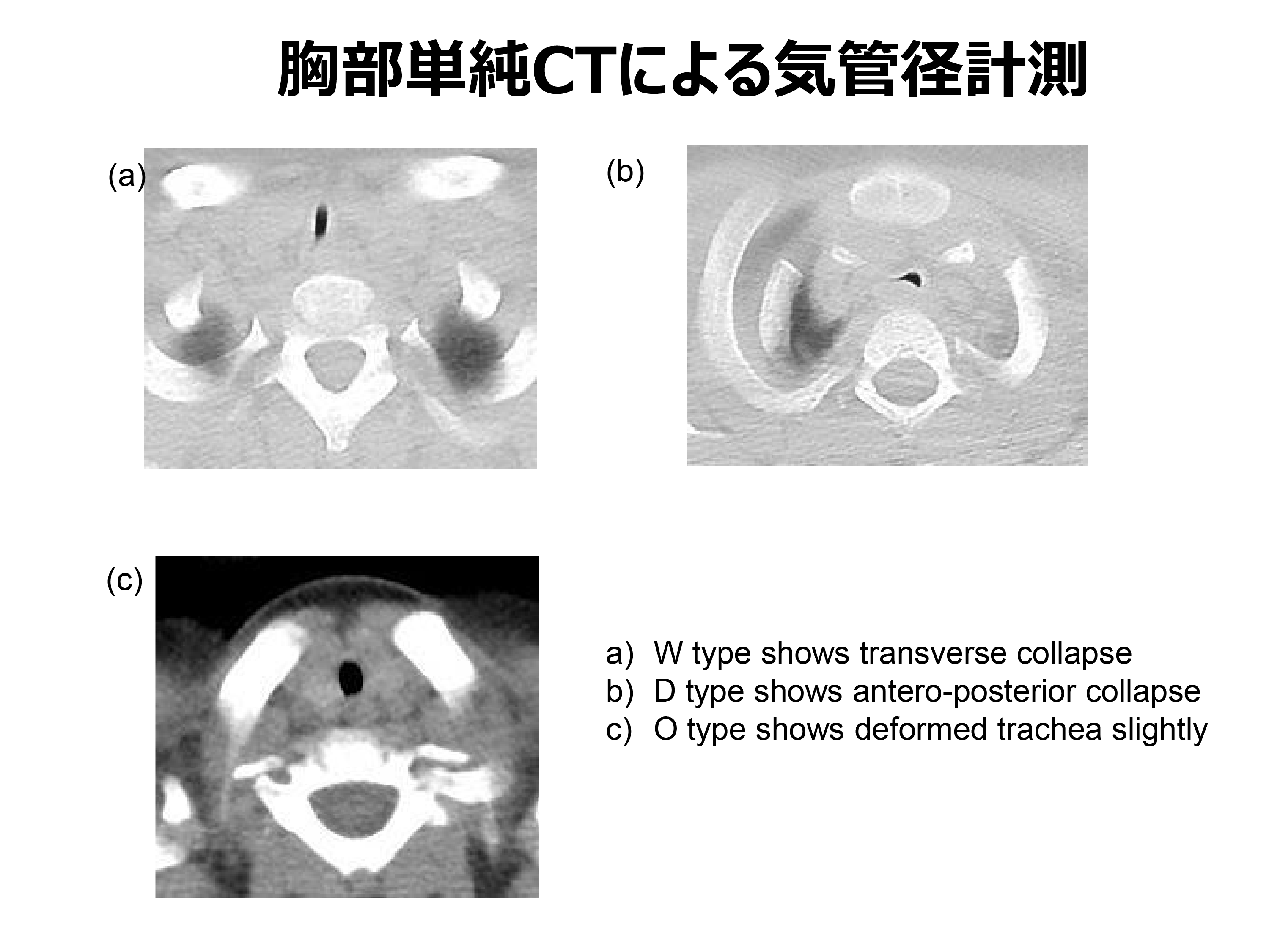図・胸部単純CTによる気管系計測
